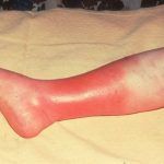 cellulitis-treatment