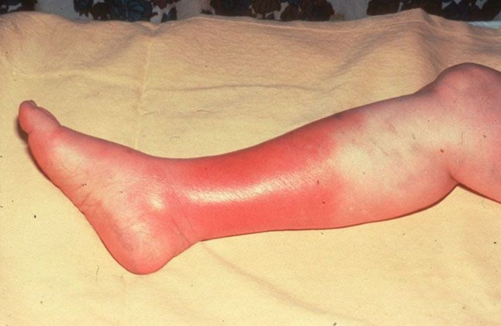 cellulitis-treatment