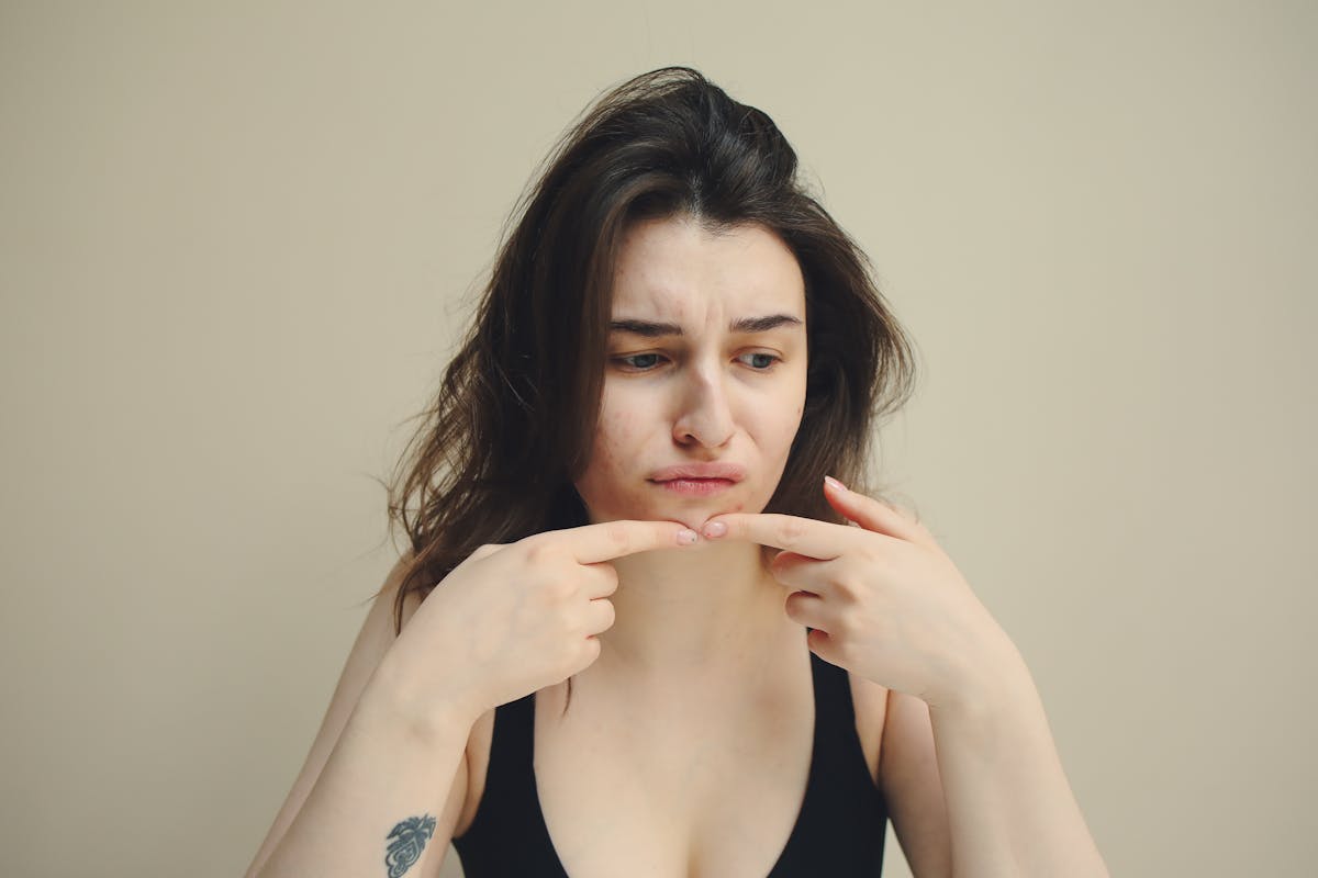 How to Fix a Painful Pimple